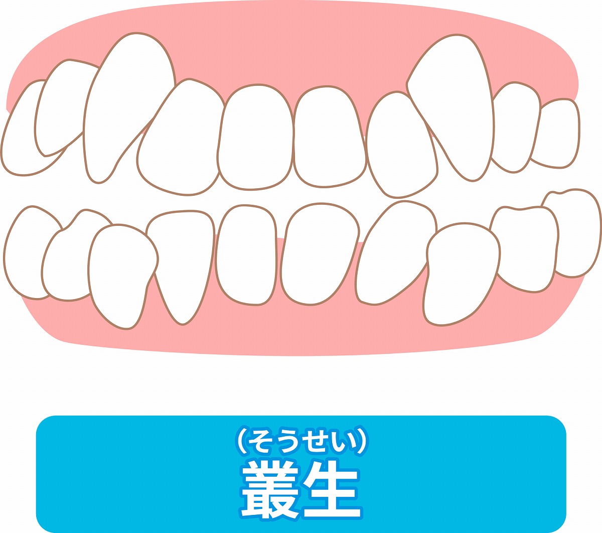 歯並びがガタガタ(叢生)ってどういう状態？