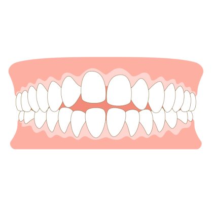 前歯で物を噛めない(開咬)
