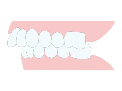 子供の出っ歯(上顎前突)ってどういう状態？